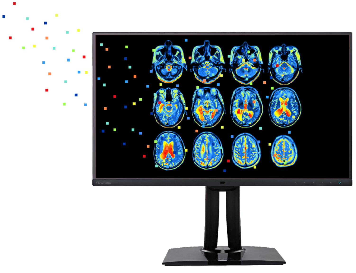 Brain scans, showing glucose levels, that help researchers diagnose degenerative diseases with artificial intelligence